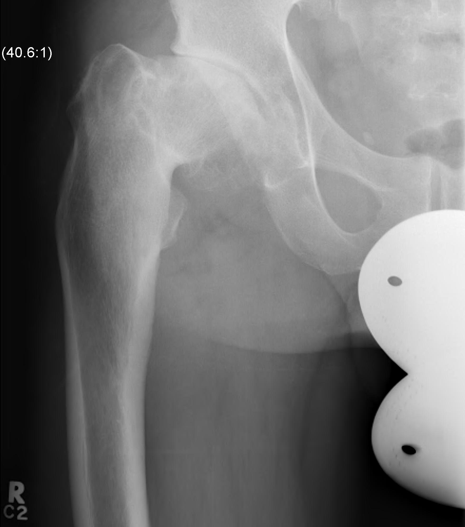 Perthes OA previous osteotomy